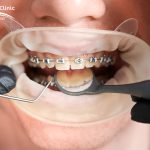 ارتودنسی دندان چیست؟ همه چیز درباره ارتودنسی
