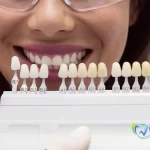 لمینت دندان چیست؟ معایب و مزایا