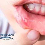 آفت دهان چیست؟ علائم + درمان 🦷
