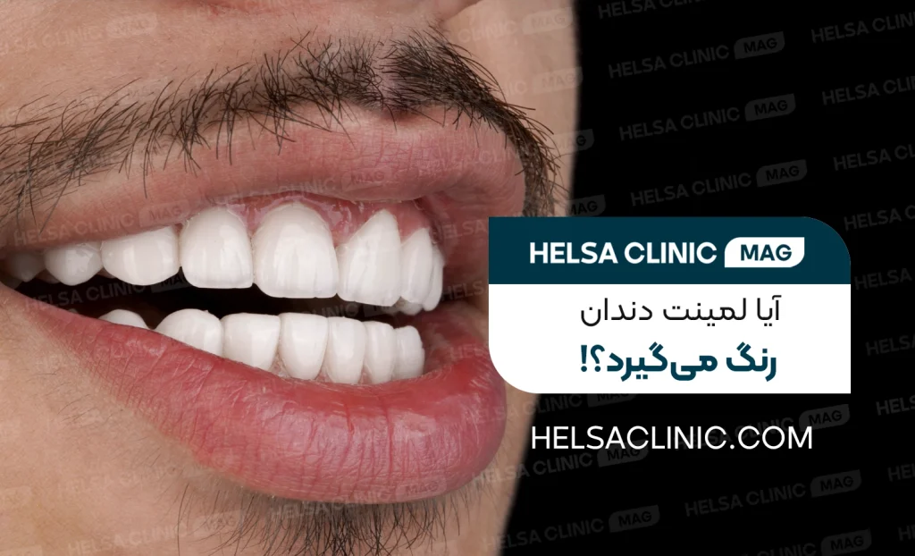 آیا لمینت دندان رنگ میگیرد؟ تصویر اختصاصی کلینک هلسا